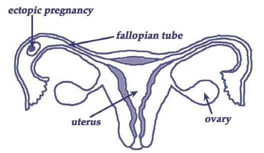 A diagram showing the uterus, ovaries, fallopian tube and an ectopic pregnancy located in fallopian tube